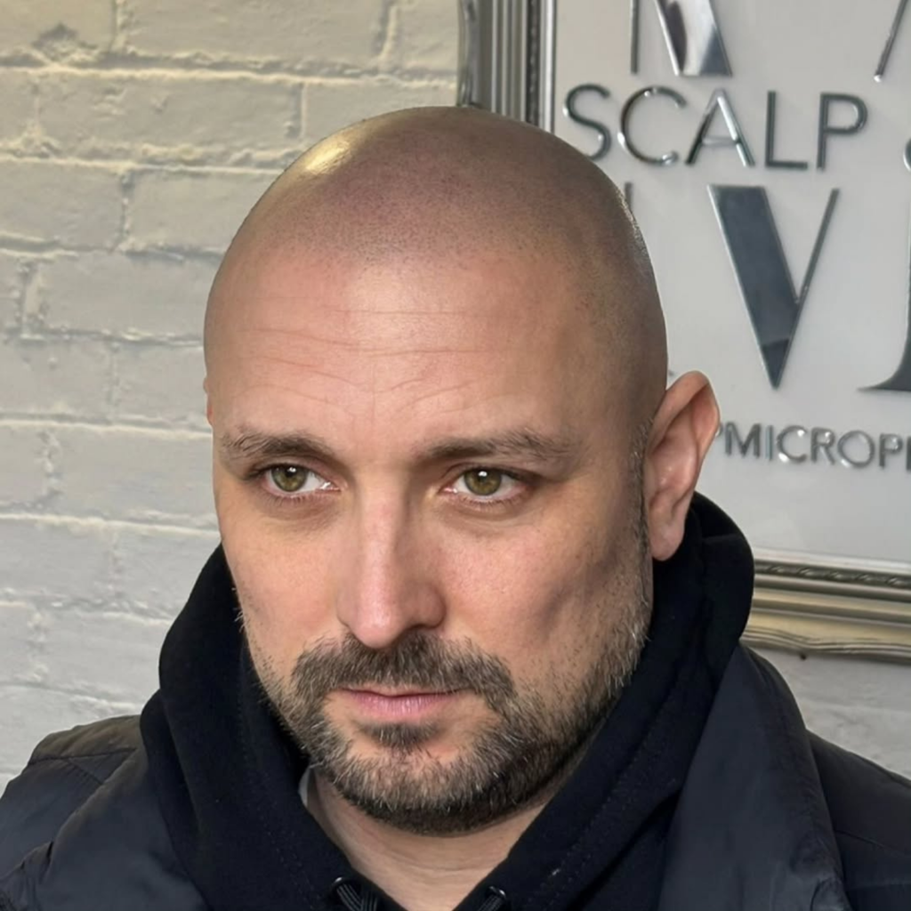 Bald head smp treatment with realistic hair follicle effect by mc scalp in hemel hempstead