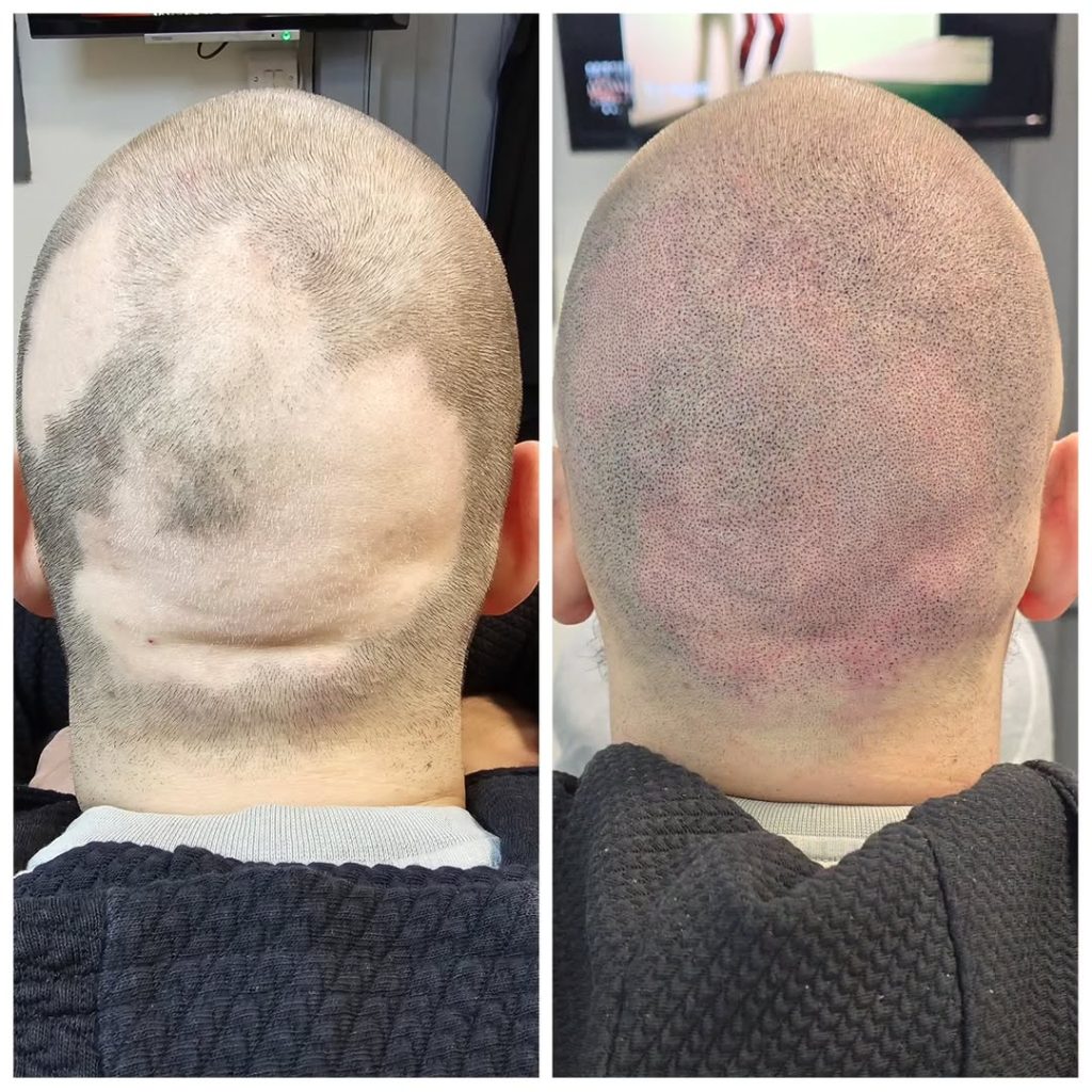 Before and after smp treatment for alopecia improving scalp coverage at mc scalp hemel hempstead