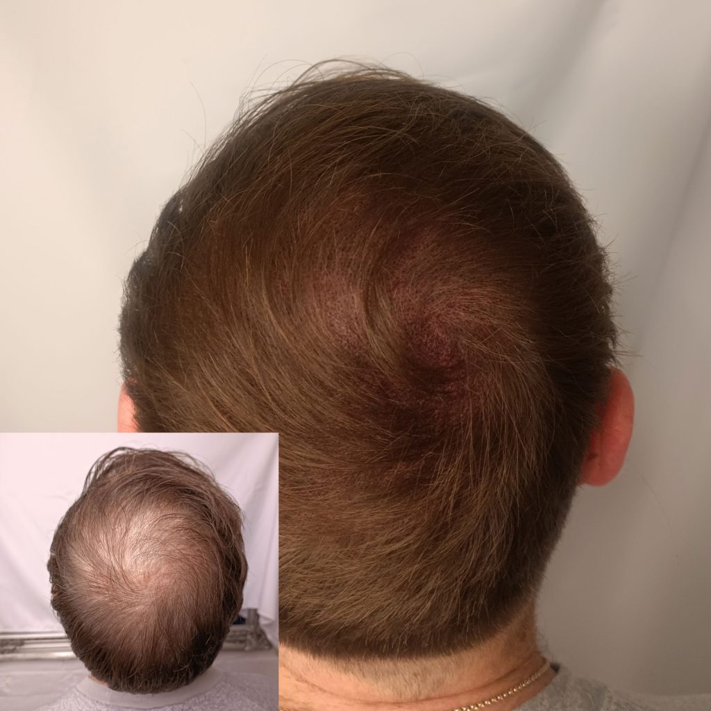 Scalp micropigmentation density treatment for thinning hair by mc scalp in hemel hempstead