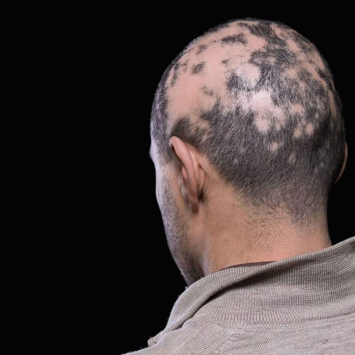 Smp treatment for alopecia improving scalp coverage and hair appearance at mc scalp in hemel hempstead