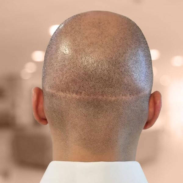 Scalp micropigmentation for scar camouflage blending scar into natural hair at mc scalp hemel hempstead