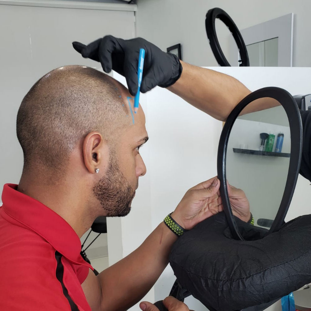 Professional scalp micropigmentation session in progress at mc scalp clinic in hemel hempstead