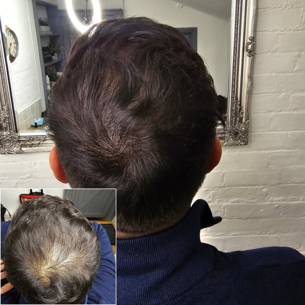 Natural-looking smp density enhancement adding fullness to thinning hair at mc scalp hemel hempstead